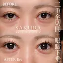 二重全切開＋眼瞼下垂 before画像 サムネイル用