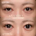 二重全切開＋眼瞼下垂 after画像 サムネイル用