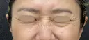 鼻筋ボトックス before画像 サムネイル用