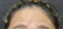 額ボトックス before画像 サムネイル用