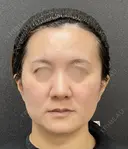 PDO糸リフト before画像 サムネイル用