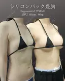 シリコン豊胸 before画像 サムネイル用