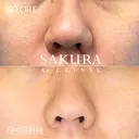 毛穴治療・ピコフラクショナル(6回) after画像 サムネイル用