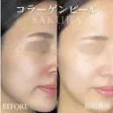 コラーゲンピール(マッサージピール) before画像 サムネイル用