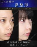 鼻尖形成・小鼻縮小・貴族プロテーゼ after画像 サムネイル用