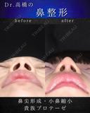 鼻尖形成・小鼻縮小・貴族プロテーゼ before画像 サムネイル用