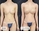 コンデンスリッチ脂肪豊胸 30日後 サムネイル用