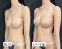コンデンスリッチ脂肪豊胸 before画像 サムネイル用