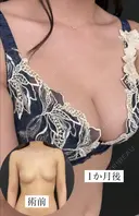 コンデンスリッチ脂肪豊胸 before画像 サムネイル用