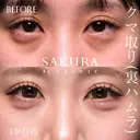 クマ取り(裏ハムラ法) before画像 サムネイル用