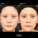 JJ 鼻中隔延長術＋鼻背部軟骨移植術 before画像 サムネイル用