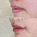 加賀デザイン×口角挙上 after画像 サムネイル用
