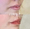 加賀デザイン×口角挙上 after画像 サムネイル用