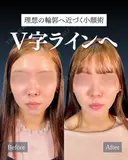 岩﨑先生による🔥小顔整形🔥 before画像 サムネイル用
