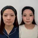 頬、顎下、ジョール脂肪吸引 before画像 サムネイル用
