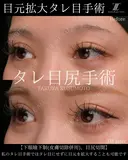 『これがタレ目尻手術の実力』 90日後 サムネイル用