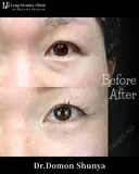 切らない目の下のたるみ取り before画像 サムネイル用