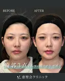 輪郭3点（頬・エラ・オトガイ骨切り） before画像 サムネイル用