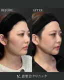 輪郭3点（頬・エラ・オトガイ骨切り） after画像 サムネイル用