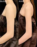 【二の腕】ベイザー併用アキーセル脂肪吸引 after画像 サムネイル用