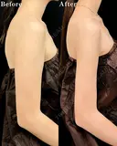 【二の腕】ベイザー併用アキーセル脂肪吸引 after画像 サムネイル用