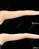 【二の腕】ベイザー併用アキーセル脂肪吸引 after画像 サムネイル用