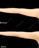【二の腕】ベイザー併用アキーセル脂肪吸引 after画像 サムネイル用