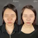 鼻整形－複合－＋小顔整形 before画像 サムネイル用