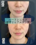 ハートシェイプ（頬骨下ヒアルロン酸） before画像 サムネイル用