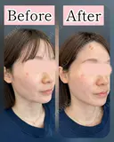 ハートシェイプ（頬骨下ヒアルロン酸） after画像 サムネイル用