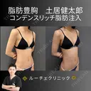 コンデンスリッチ脂肪豊胸 before画像 サムネイル用