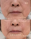 法令線ヒアルロン酸 before画像 サムネイル用