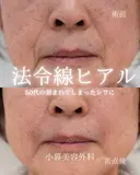 法令線ヒアルロン酸 0日後 サムネイル用