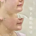 加賀デザイン×顎下脂肪吸引 after画像 サムネイル用