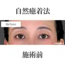 自然癒着法 before画像 サムネイル用