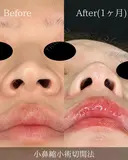 小鼻縮小切開法(内側) after画像 サムネイル用