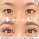 1週間でもう可愛い♡MD式全切開法二重術+MD式眼瞼下垂手術※たるみ取り併用 before画像 サムネイル用