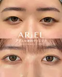 アリエルクイックループ（二重埋没法） 7日後 サムネイル用
