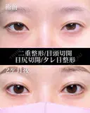 二重埋没法/目頭切開/目尻切開/タレ目整形 before画像 サムネイル用