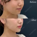 ベイザー併用アキーセル脂肪吸引＋バッカルファット除去 before画像 サムネイル用