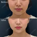 ベイザー併用アキーセル脂肪吸引＋バッカルファット除去 after画像 サムネイル用
