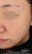 美人レーザー before画像 サムネイル用