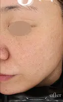 美人レーザー 60日後 サムネイル用
