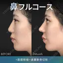 鼻フルコース（鼻複合自家組織移植術）＋筋膜移植 before画像 サムネイル用