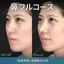 鼻フルコース（鼻複合自家組織移植術）＋筋膜移植 90日後 サムネイル用
