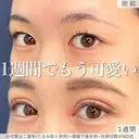 1週間でもう可愛い♡MD式全切開法二重術+MD式眼瞼下垂手術※たるみ取り併用 before画像 サムネイル用