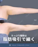 シンデレラ脂肪吸引(二の腕・肩) 150日後 サムネイル用