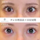 タレ目＋目尻切開 before画像 サムネイル用