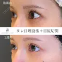 タレ目＋目尻切開 14日後 サムネイル用