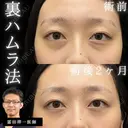 クマ取り🐻裏ハムラ法｜形成外科専門医が担当｜明るい目元へ✨ before画像 サムネイル用